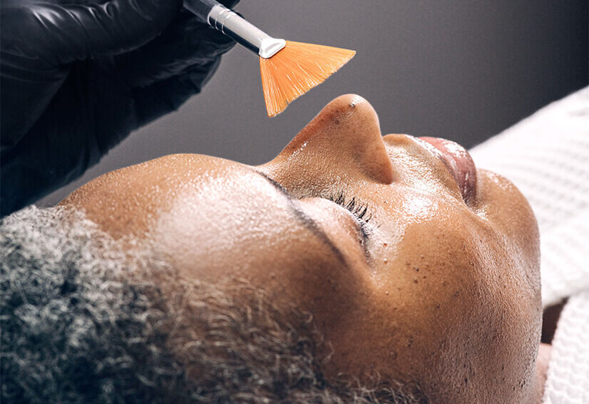 Chemische Peeling