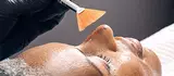 Medium chemische peeling