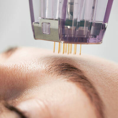 IPL Laser