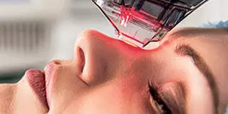 Non-Ablatieve Laser