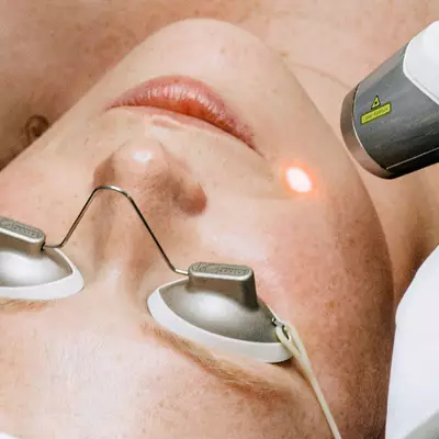 Ablative Laser