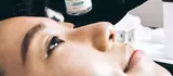 Lichte chemische peeling