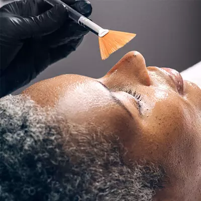 IPL Laser