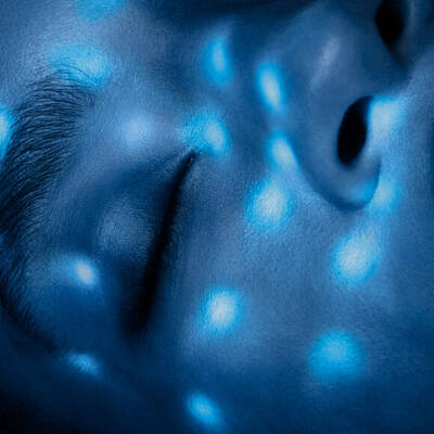 IPL-laser