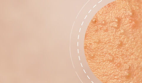 Close-up of textured skin, showing pores and small imperfections, against a soft blurred background.