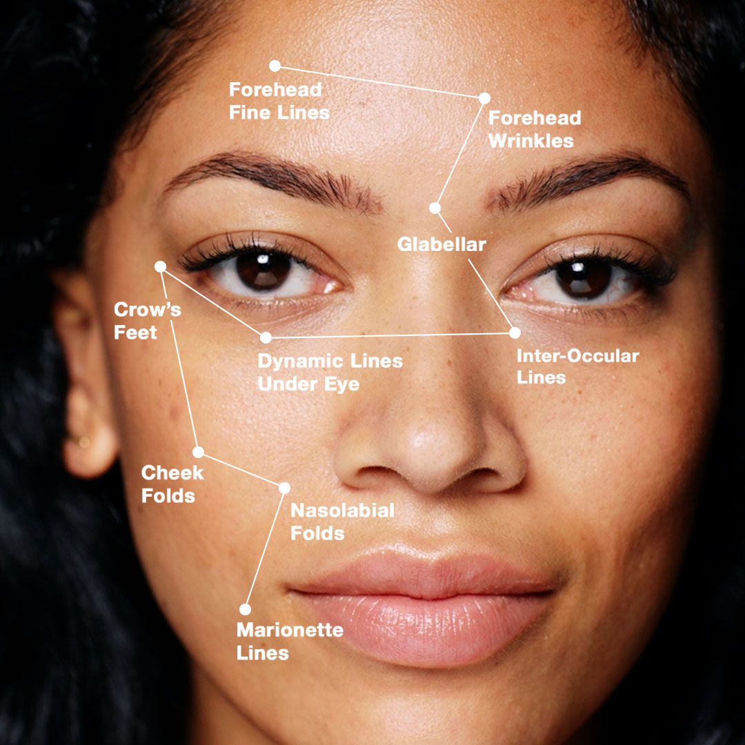 Gezicht met labels voor rimpels en lijnen zoals voorhoofdslijnen, kraaienpootjes, en marionettenlijnen.