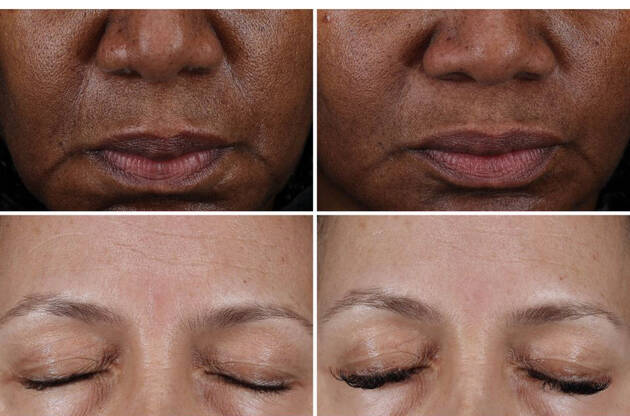 Vergelijking van huid voor en na 8 weken behandeling, met zichtbaar verbeterde teint en vermindering van rimpels.