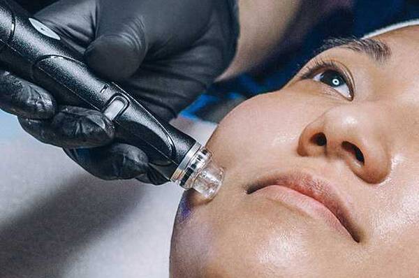 Een close-up van een gezicht van een persoon die een huidbehandeling ondergaat met een apparaat, terwijl een hand met zwarte handschoenen het apparaat vasthoudt.