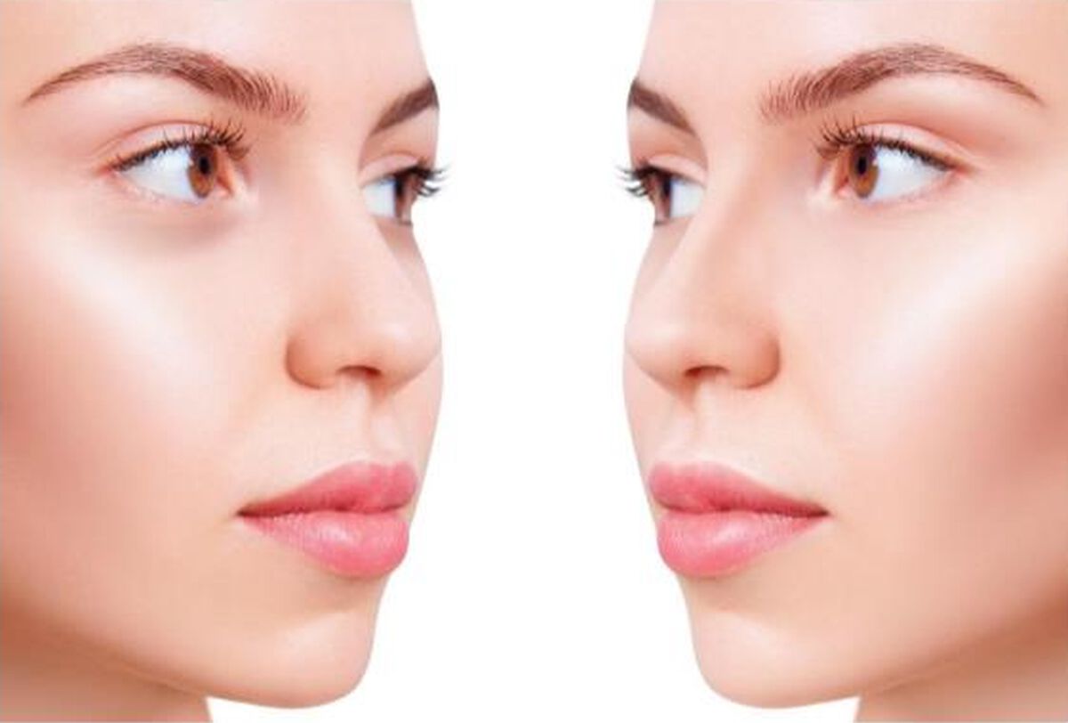 donkere-kringen-onder-ogen-verminderen